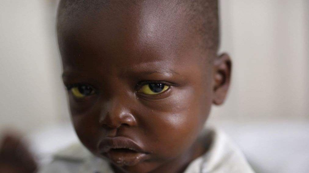 WHO upozorava na epidemiju žute groznice u Etiopiji